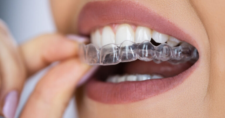 invisalign em franco da rocha